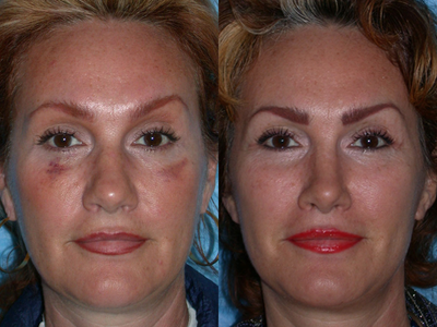 Rhinoplasty - 
	This primary rhinoplasty patient sustained a severe nasal/septal fracture that required repair via an open rhinoplasty approach. Her broad, bulbous tip was corrected at the same time.
