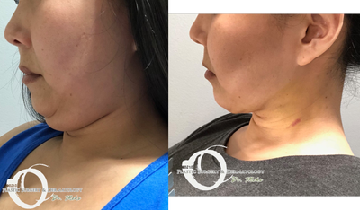 20-30 year old woman treated with chin liposuction - Before and after chin liposuction! Side view and chin tucked in before and afterLocal anesthesia fully awake. After photos are 6 days post op