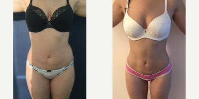35-44 year old woman treated with Liposuction - Amazing post op results in this 36 year old patient from San Francisco, California two months after 360 liposuction and Brazilian butt lift with Premium Care. Surgical time was minimized using two plastic surgeons, and she spent 10 days after surgery recovering in Cartagena at our five star Recovery Suites. Her figure looks amazing!