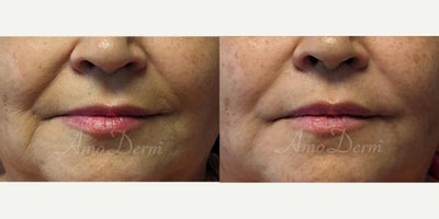 65-74 year old woman treated with Juvederm, Vollure - Treatment of nasolabial folds (laugh lines) and marionette lines with Juvederm, Radiesse, Vollure, Restylane or Bellafill injected with cannula