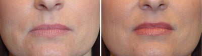 35-44 year old woman treated with Restylane Silk - Restylane Silk