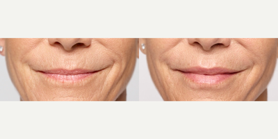 Woman treated with Restylane Silk - Photo provided courtesy of Galderma
