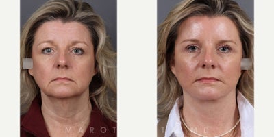 Woman treated with Facelift, Eyelid Surgery - Woman treated with Facelift, Eyelid Surgery