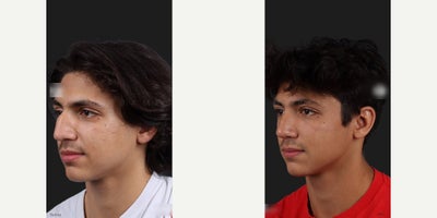 Man treated with Septoplasty - Man treated with Septoplasty