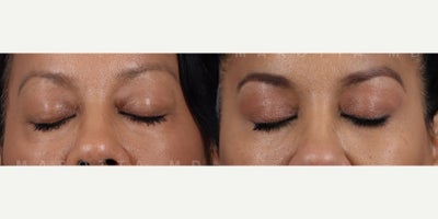 Woman treated with Eyelid Surgery - Woman treated with Eyelid Surgery