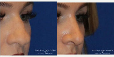25-34 year old woman treated with Rhinoplasty - Patient had cosmetic rhinoplasty