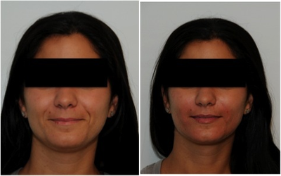 Evolence Injection in Smile Lines - Patient had 1.6 cc of Evolence injected into her smile lines (nasolabial creases). She is shown before and immediately after. Notice the smoothness of the creases after the injection. 