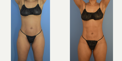 25-34 year old woman treated with Brazilian Butt Lift, Liposculpture, Liposuction - 6-months following BBL, 360 liposuction with liposculpture, and arms liposuction. Natural and symmetric result was the goal.