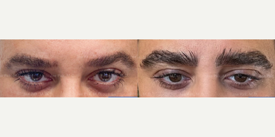 Patient treated with Eyebrow Transplant - Eyebrow Transplant