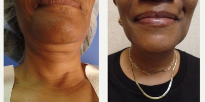 55-64 year old woman treated with FaceTite - Chin, Neck and Jowls