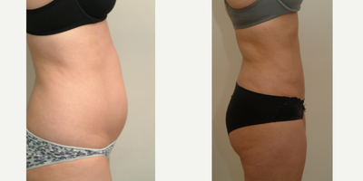 18-24 year old woman treated with Mini Tummy Tuck - Mini-Tummy Tuck