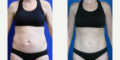 35-44 year old woman treated with SculpSure - This patient is shown 6 weeks after Sculpsure non surgical laser fat melting of her abdomen. She has had no increased exercise and no weight loss.
