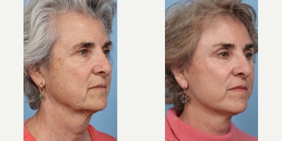 65-74 year old woman treated with Deep Plane Facelift, Brow Lift, Eyelid Surgery - 3 months post op
