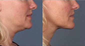 Woman treated with Nonsurgical Neck Lift, Kybella - Woman treated with Nonsurgical Neck Lift, Kybella
