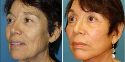 70 year old woman treated with Facelift - Got neck bands?! I got a solution! A facial rejuvenation of a mid 70 year old with a facelift and platysmaplasty(suturing up the neck muscles) Pay close attention to her jowls, jawline and obviously her neck.