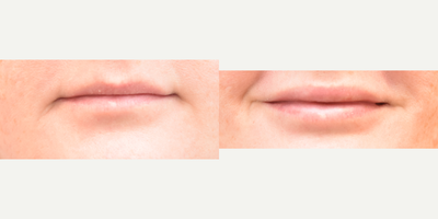 35-44 year old woman treated with Lip Implants - Permalip implants