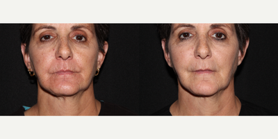 55-64 year old woman treated with Volbella - Treated with Volbella