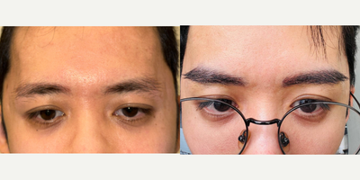 35-44 year old man treated with Eyebrow Transplant - Male 24 years old, had eyebrow transplantation with long hair FUE. We add follicular unit to increase the density of both eyebrow.
