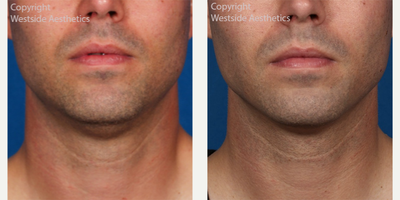 Kybella Double Chin Treatment - This 35-year-old male patient was concerned with the slight droop below his chin that caused his jaw to look less defined. Dr. Rivkin administered Kybella, a non-surgical injectable, to reduce moderate to severe fat on the upper neck, otherwise known as a double chin.
