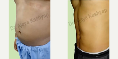 Man treated with Body-Jet Liposuction, Liposuction - Man treated with Body-Jet Liposuction, Liposuction