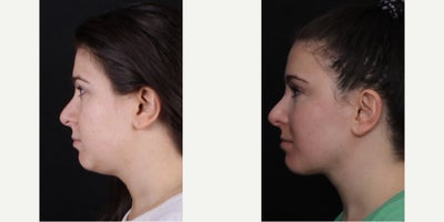 25-34 year old woman treated with Neck Lift, Chin Liposuction - Love seeing these great results after a deep neck lift and liposuction below the jawline! For this result, we combined liposuction laterally under the jawline, removed the deep fatty tissues under the floor of the mouth, and contoured and tightened the central muscles of the neck to get a sharper neck angle and more defined jawline. As we know, it's not the modalities we use, it's the RESULT that's important along with reducing recovery time as much as feasible! Thank you to this beautiful patient for letting us share these photos.
