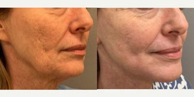 55-64 year old woman treated with Laser Peel - TRL laser resurfacing in the peri-oral area (around the mouth) in our office.