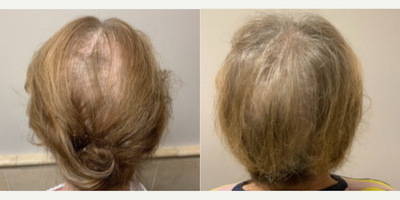 Man treated with Hair Transplant - Man treated with Hair Transplant forHair Loss Treatment
