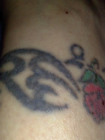laser tattoo removal what are the advantages and laser tattoo removal what are the advantages and
