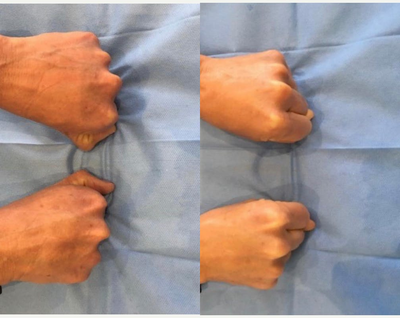 45-54 year old woman treated with Ellanse - This patient was treated with Ellanse M to the hands, to both restore volume to hide the veins and tendons but also to improve the skin appearance by its secondary effect of collagen stimulation