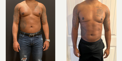 35-44 year old man treated with Liposuction - High Definition HD Liposuction performed by Dr. Johnny Franco