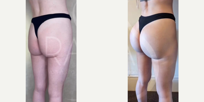 Woman treated with Butt Implants - Woman treated with Butt Implants