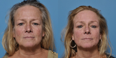 New HALO Resurfacing Laser -- Minimal Downtime with Maximal Results - This patient underwent the new Sciton HALO laser resurfacing which is a combination ablative / non-ablative laser. Unlike other laser resurfacing procedures, she was allowed to wear makeup the very next day which minimized her downtime significantly. Although she was swollen for a couple of days, she was able to go about her usual activities. The laser is used for sun damaged skin to remove unwanted pigment and to treat fine lines, giving you a brighter look.