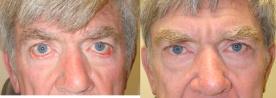 Ectropion surgery and Canthoplasty - 	This middle-age man underwent bilateral lower eyelid ectropion (eyelid turning out) surgery and canthoplasty.