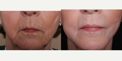 Hetters Peel around the mouth and Fat Injections - Patient was concerned about aging around the mouth. She had fat injections to upper and lower lips and a Hetter's Peel to help improve texture and decrease the fine lines. The Hetter's Peel tightens the skin and will continue to improve over the next 6 months.