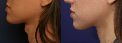 Patient treated with Adam's Apple Reduction - Patient treated with Adam's Apple Reduction