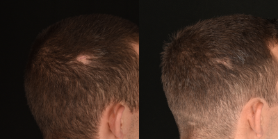 25-34 year old man treated with Hair Loss Treatment - Our blood consists of two main components, red blood cells and plasma. The plasma contains white blood cells and platelets that are rich in growth factors. By extracting and isolating these growth factors, specifically the platelet-rich fibrin or #PRF, we can harness the all-natural regenerative properties to stimulate the activity of hair follicles to promote new hair growth. There are no additives to this meaning this all-natural treatment is entirely from ones own body. Anyone experiencing hair loss is essentially a good candidate for PRF treatments, especially those who are experiencing early signs of hair loss.