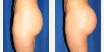 Woman treated with Butt Augmentation - Woman treated with Butt Augmentation