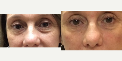 55-64 year old woman treated with Vollure - tear trough treatment with Vollure