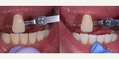 35-44 year old man treated with Zoom Whitening - After 75 minutes of the new and improved Zoom tooth whitening system
