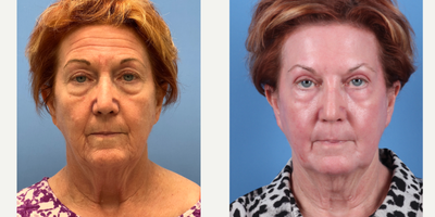70 year old woman treated with Phenol Peel - Dr. Sam Sukkar performed a Phenol Peel on this 70 year old patient. Post-Op photos taken at just 3 months after procedure.