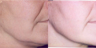 45-54 year old woman treated with TITAN - TITAN skin Tightening treatments every 3 weeks x 2 to improve the sagging jawline