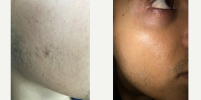 35-44 year old woman treated with Mole Removal - Mole removal with shave excision and Mixto co2 laser