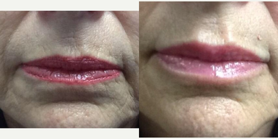 65-74 year old woman treated with Restylane Silk - For women who are looking for an enhanced lip and smoothing their perioral wrinkles (lines around the mouth), with a subtle and natural approach, Restylane Silk is an outstanding option.