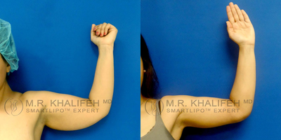 25-34 year old woman treated with Laser Liposuction - Awake smartlipo patient undergoing arm sculpting with laser lipolysis followed by liposuction.