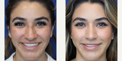 Woman treated with Rhinoplasty - Woman treated with Rhinoplasty