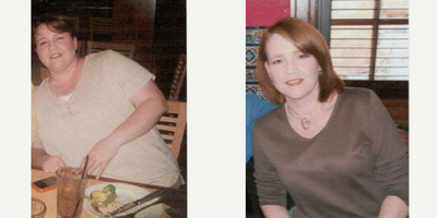 45-54 year old woman treated with Gastric Bypass - Gastric bypass