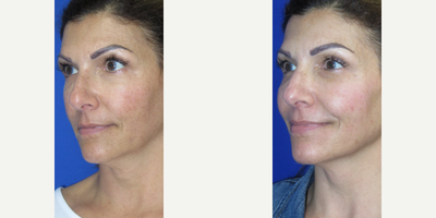 Woman treated with Profound RF - Check out the results of this patient who wanted a non-surgical treatment to address the sagging jowls in her lower face and skin laxity around her neck. Profound RF was used to treat her concerns which significantly contoured her jawline and redefined her neck with only one treatment (7 month results)