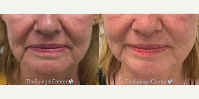 65-74 year old woman treated with Ellacor - Ellacor