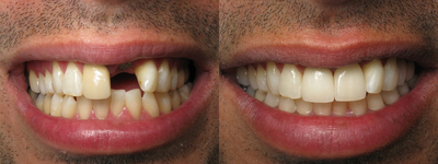 Crown Replacement & Implant Crown Before & After Photo - 
	Patient had old crown replaced and implant crown with zirconia abutement.
