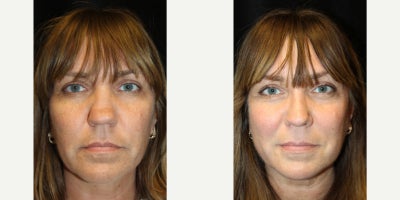 45-54 year old woman treated with Septoplasty - This patient came to Dr. Gowda seeking a natural, functional change. Through precise use of spreader grafts, using a graft from her rib cartilage for reconstruction, and septoplasty, he improved both airway flow and internal support. The result: a nose that functions better and looks naturally enhanced.